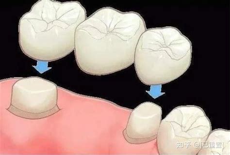 牙齿缺失的三种修复方式 知乎