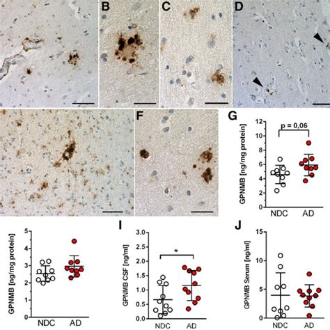 GPNMB IBA 1 Positive Microglia Cells Cluster Around Individual Plaque