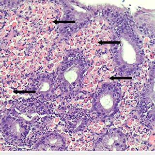 H&E stain demonstrating Russell bodies within B-cells in the lamina ...