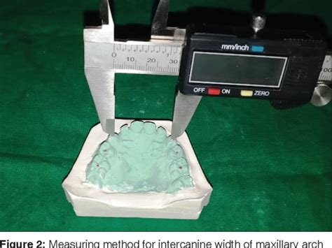 Figure 1 From Sex Determination Using Maxillary Arch Width Of Pediatric