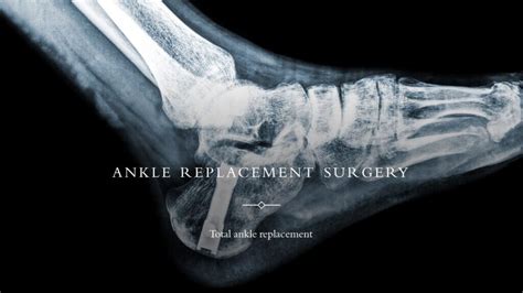 Ankle Replacement Surgery: Use, Procedure, Risks