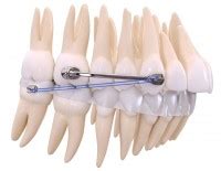 PowerBar Class II Corrector American Orthodontics