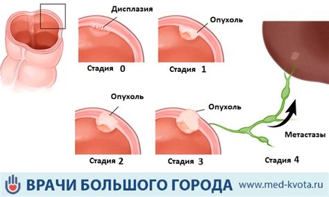 Рак ободочной кишки фото первые симптомы и признаки виды причины