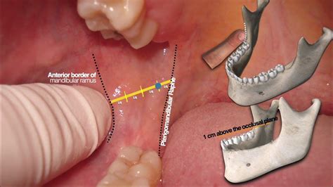 Alveolar Inferior Nerve Block The Best Straightforward Explanation Ever Youtube