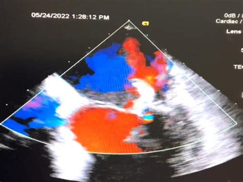 Moderate Mitral Valve Regurgitation Download Scientific Diagram