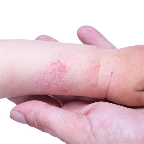 What Is Allergic Eczema? - Prozema