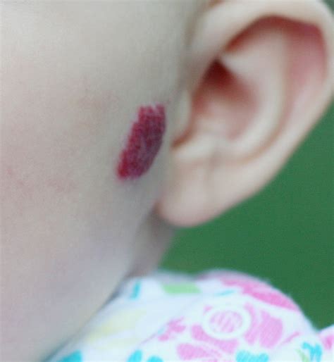 Mortensen Hemangiomas