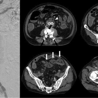 Pre-procedural images: CT images show infrarenal AAA (5.0 cm). There is ...