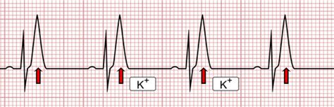 Alteraciones En El Electrocardiograma