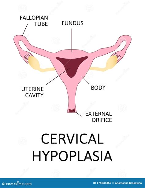 Hipoplasia Uterina útero Ou útero Infantil Ilustração Stock