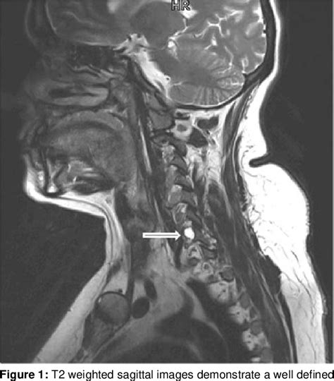 Figure 1 From Juxtafacet Cyst Of Cervical Spine A Rare Neural Foraminal Lesion Semantic Scholar