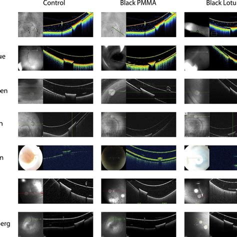 SLO/OCT Imaging through Occlusive IOLs | Download Table