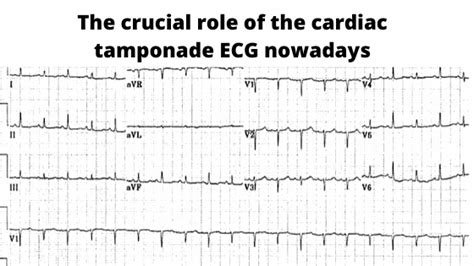 Cardiac Tamponade Ecg Changes