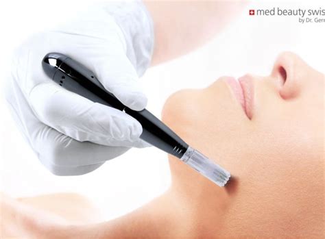 Microneedling In M Nchen Sthetik Kosmetik Institut Nymphenburg