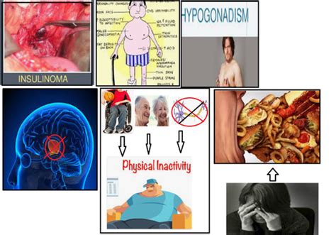 28 Etiology And Pathogenesis Of Obesity Metabolic Syndrome