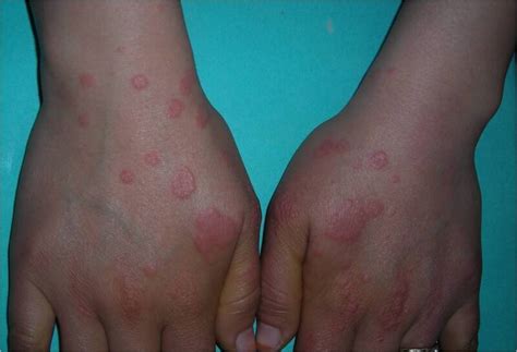 Erythema Multiforme Statpearls Ncbi Bookshelf