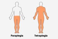 Parafimosis qué es síntomas y tratamiento Tua Saúde