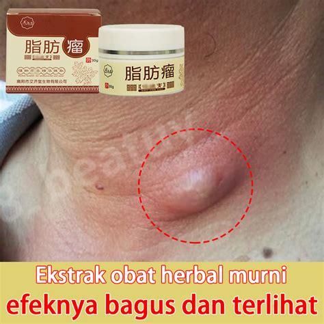 Jual Obat Benjolan Di Leher Obat Benjolan Payudara Obat Kelenjar Getah