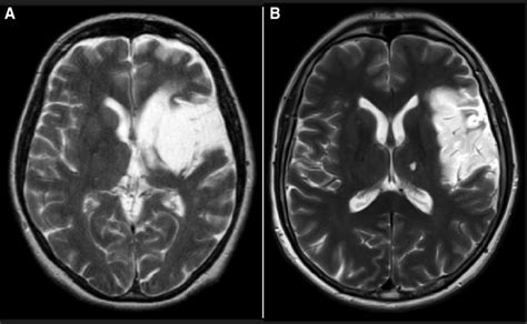 T 2 Weighted MRI Scans Axial View Of Patients PR A And AS B Both