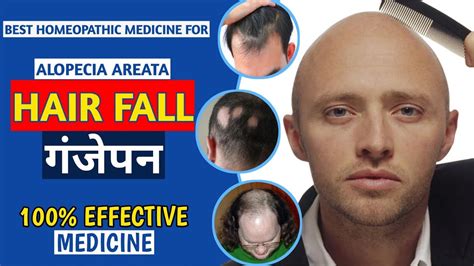 बाल झड़ना कैसे रोके Hair Fall Dr S S Pandit गंजेपन Homeopathic