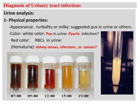 Ppt Urinary Tract Infection Uti Powerpoint Presentation Free