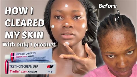 THE TRETINOIN NIGHT ROUTINE THAT CLEARED MY SKIN Step By Step