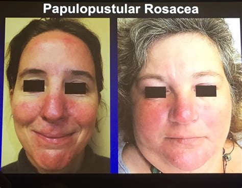 Rosacea Vs Lupus Butterfly Rash