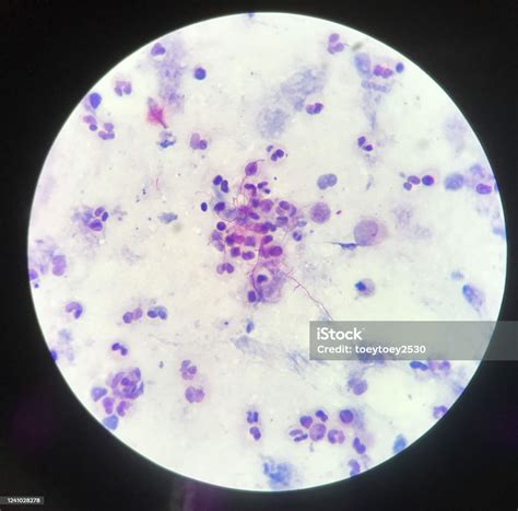 Red Branching Mycobacterium Tuberculosis On Blue Background In Modified Acid Fast Bacilli