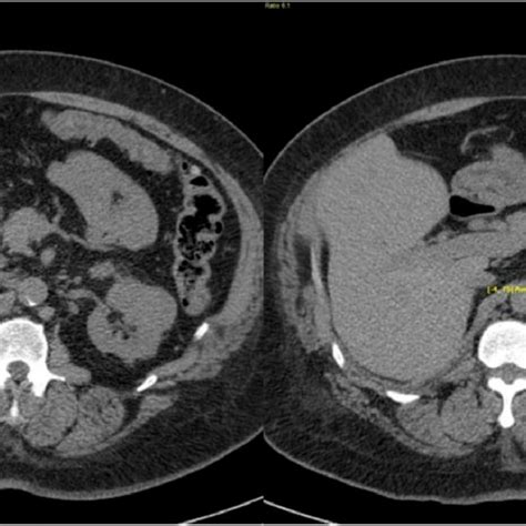 Pdf Mifepristone Treatment In Four Cases Of Primary Bilateral