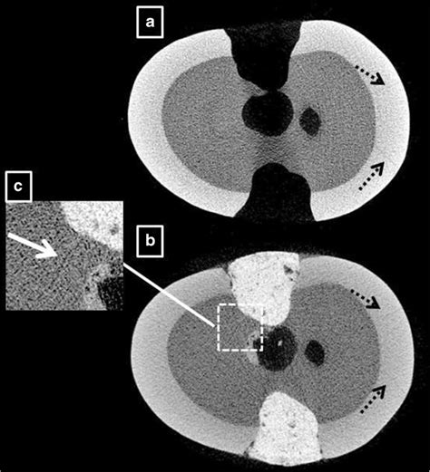 Representative Micro CT Images Of A Sample Before A And After B