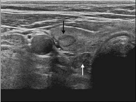 Preoperative neck ultrasound. Black arrow, thyroid adenoma; white ...