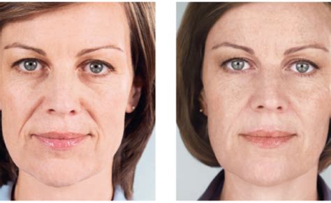 Injectables Archives Cosmetic Skin Institute Skin Care In