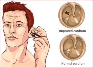 Tympanic Membrane Perforation: Symptoms, Causes, and Treatment Options