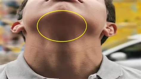 How To Get Rid Of Ingrown Hair Bumps Under Chin Naturally Youtube