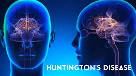 Physical Therapy For Huntingtons Disease Reddy Care Physical