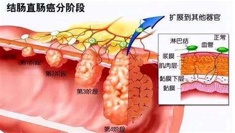 结直肠癌的高危因素及人群筛查指南 · 科普中国网