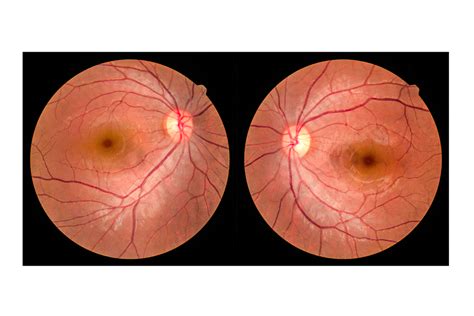 The Importance Of Eye Exams For Diabetics Vision Care Direct