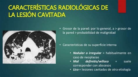 Lesiones Pulmonares Cavitadas