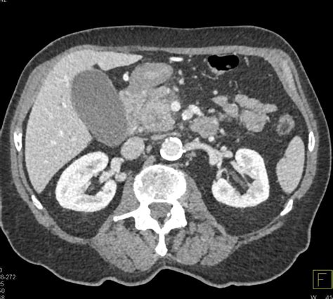 Pancreatic Cancer Invades The Pv Smv Sv Junction Pancreas Case