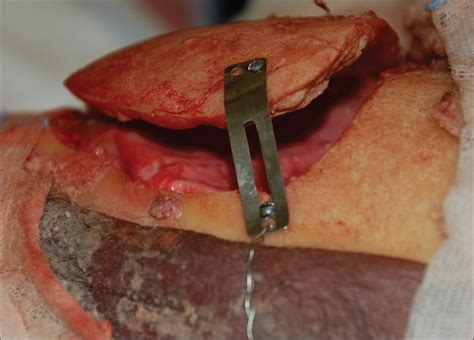 Fronto Parietal Craniotomy Showing The Sf Device In Place Keeping The