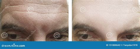 Male Face Wrinkles Removal Aging Forehead before and after Treatment ...