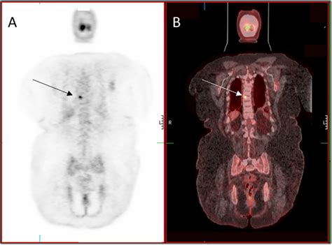 Tumor Induced Osteomalacia Pmc