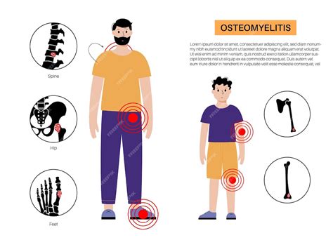 Enfermedad De Osteomielitis En Adultos Y Niños Huesos Infectados De La