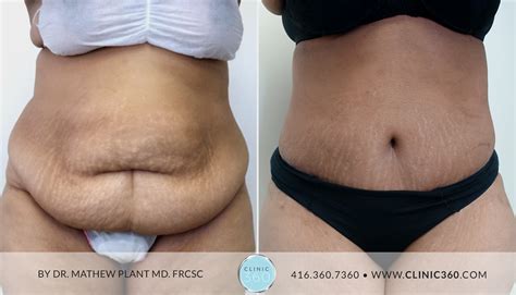 How To Get A Tummy Tuck For Free Canada Franchesca Sawyer