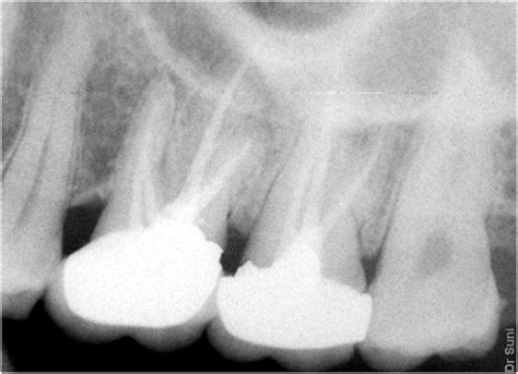 Anatomical Aberrations In Root Canals Of Maxillary First And Second