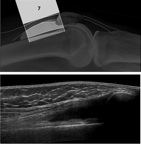 Ultrasound For Knee Effusion Lipohaemarthrosis And Tibial Plateau Fracture Rippey 2014