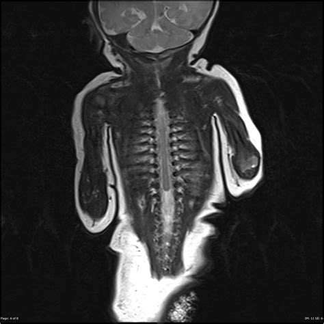 Caudal Regression Syndrome Mri