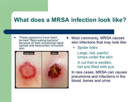 Mrsa Ppt