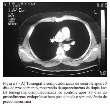 Scielo Brasil Tratamento Endovascular De Pseudoaneurisma De Aorta