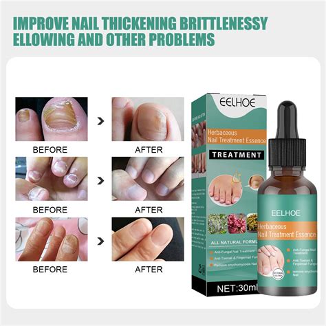 Herbaceous Fungus Nail Treatment Essence Thickening Nail Cure Liquid